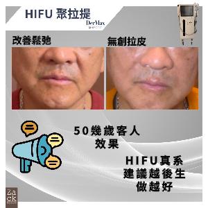 DerMax Hifu 面部提拉療程-體驗價