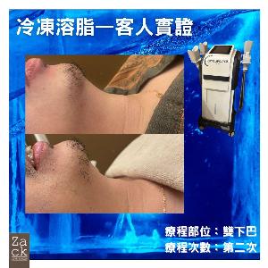 Cryolipolysis 冰感定位纖脂療程(1格)-體驗價