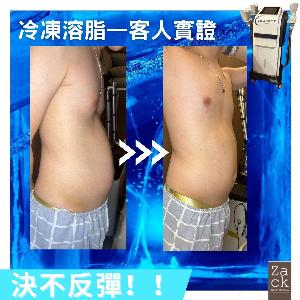 Cryolipolysis 冰感定位纖脂療程(2格)-體驗價
